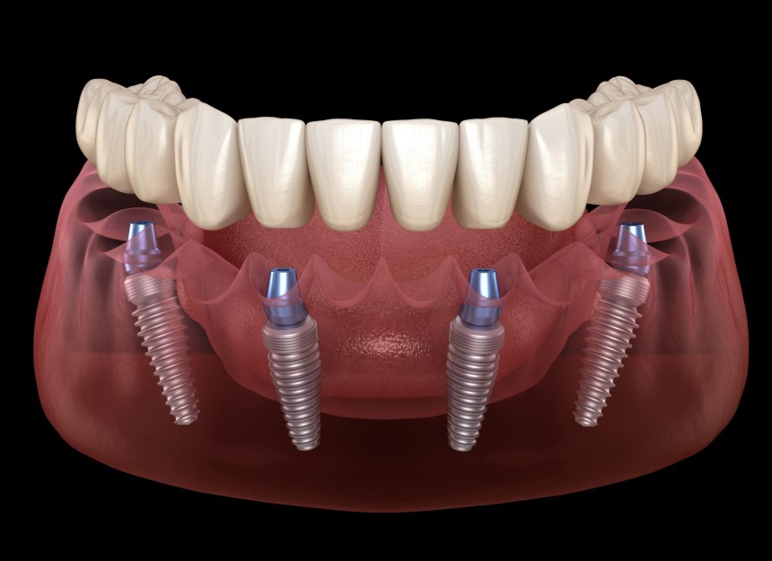 Blogs - Bang Box online - Restore Your Smile with Confidence: All-on-4 Dental Implants in San Diego